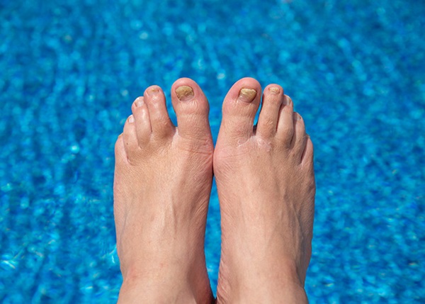 mycose-pieds-ongles
